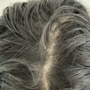 oily scalp کف سر چرب